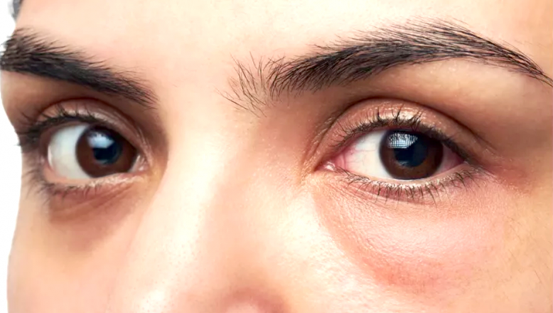 Göz altı torbaları neden olur? Ameliyatsız tedavisi nedir ?